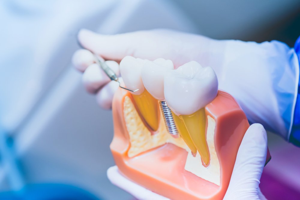 Top 5: Tooth Replacement Options